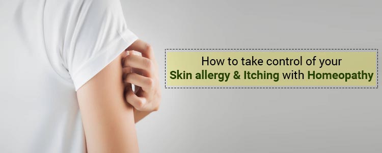 How To Take Control of your Skin Allergy & Itching with Homeopathy